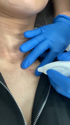 プラズマフェイシャルって？の記事動画