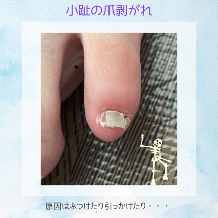 小趾の爪のトラブルにも”爪伸び育て～ぷ”の記事動画
