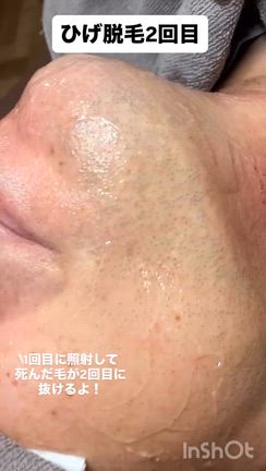 ひげ脱毛2回目の記事動画