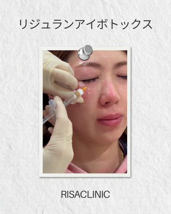 リジュランアイボトックス☆施術とダウンタイム♪の記事動画