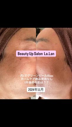 月1 グリーンピール55sec 1年後は…？？の記事動画