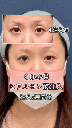 【くぼみ目ヒアル】クマ取り脱脂術でくぼんだ上まぶたを修正の記事動画