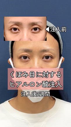 【くぼみ目治療】動画は嘘をつかない！美しい結果をご覧ください。の記事動画