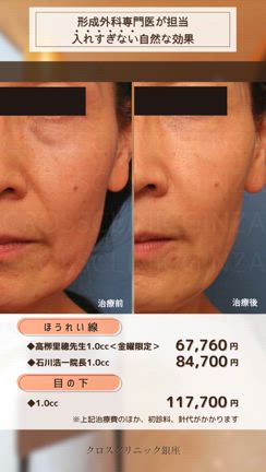 ヒアルロン酸注入｜ほうれい線・目の下のくぼみ、小ジワの記事動画