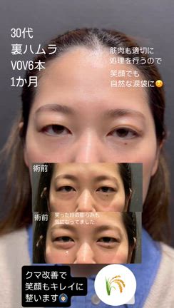 裏ハムラだけで足りる？― クマ治療で差がつく、“もう一歩先”のアプローチとは？の記事動画