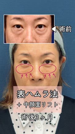 【表ハムラ＋中顔面リフト】動画もあります！自然なのに劇的変化のクマ取りの記事動画