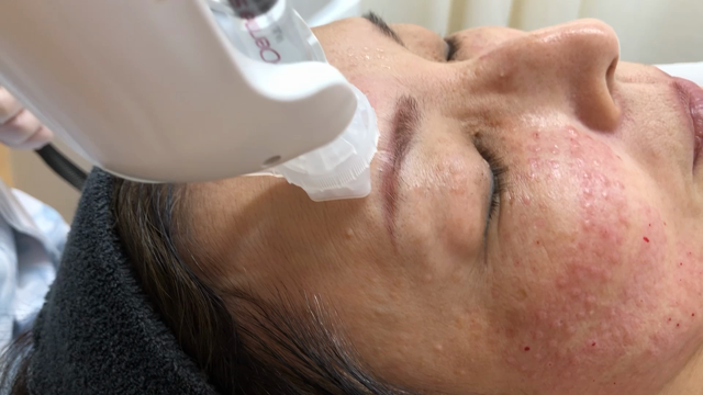 新しい水光注射機の治療が始まりますの記事動画