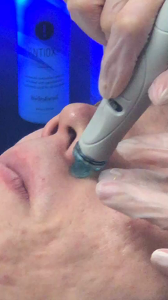 海外セレブ大絶賛「ハイドラフェイシャル」の記事動画