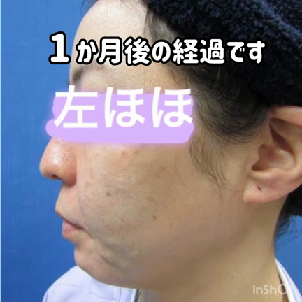 スクリュースレッドリフト④の記事動画