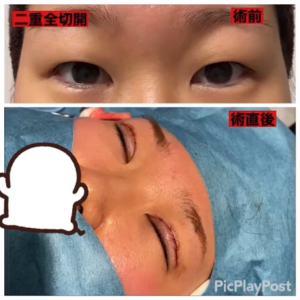 帰ってきた「二重全切開」の記事動画