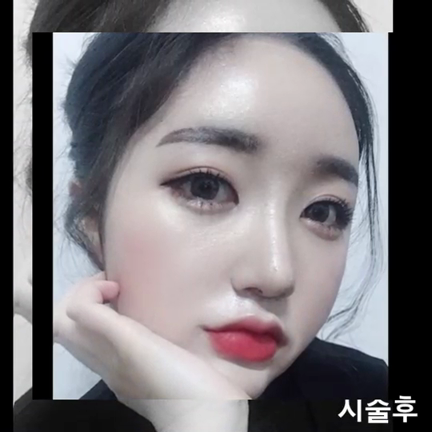 涙袋フィラー施術のロコミの記事動画