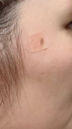 ピコスポット☆経過について♪の記事動画