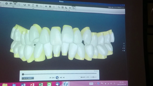 『こうざと矯正歯科』、最新最新矯正治療シミュレーション♪の記事動画