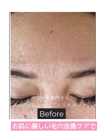 凸凹毛穴、すり鉢毛穴、開き毛穴、おでこのボコボコ、みかん肌改善！の記事動画