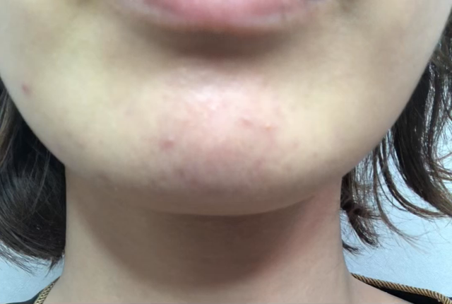 顎の梅干しシワ撃退！の記事動画