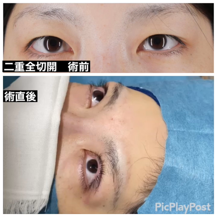 帰ってきた「二重全切開」の記事動画