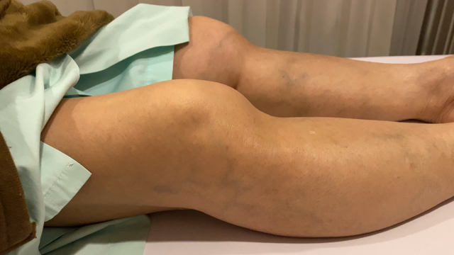 手術が決まっていた重度の変形性膝関節症が回復、その『新しい』手法とは？の記事動画