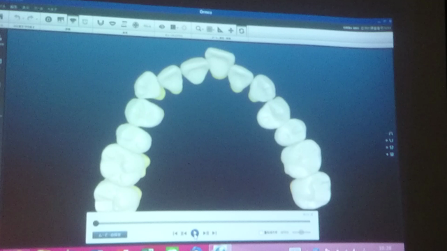 『こうざと矯正歯科』、最新最新矯正治療シミュレーション♪の記事動画