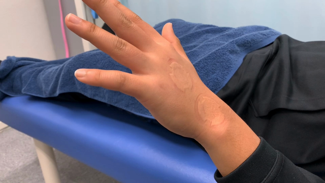 野球少年　デットボールを手の甲に受けて小指が伸びなかったけど治療後直ぐに伸びたよ。の記事動画