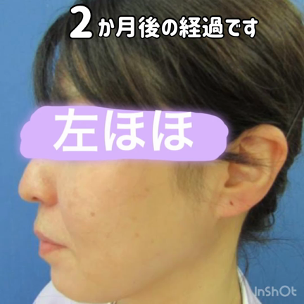 スクリュースレッドリフト④の記事動画