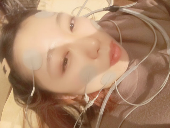 【ほんとに凄い】美容鍼初体験レポ《2327》の記事動画