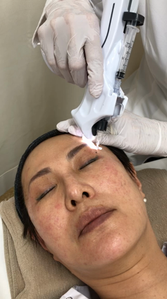 ウルティムガンでスネコス治療（治療後の写真を普通の注入法と比べてください）の記事動画