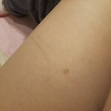 ✨シミ取りレーザー✨の記事動画