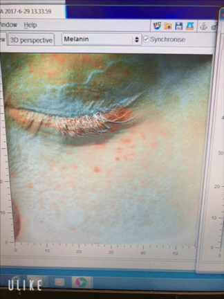 アンテラで肌の内側をチェック☆の記事動画