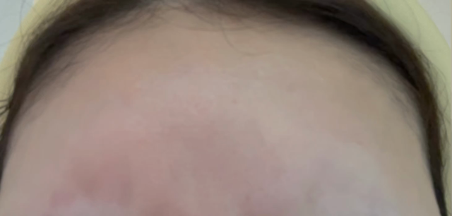 額ボトックスの記事動画