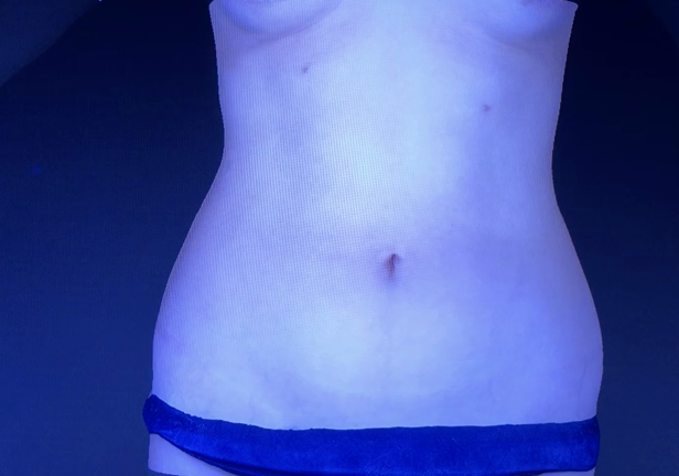 欲張りなナース、、、、7日目の抜糸です。動画の記事動画