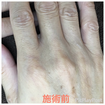 手の指&amp;手の甲お試し ¥5000→¥3000の記事動画