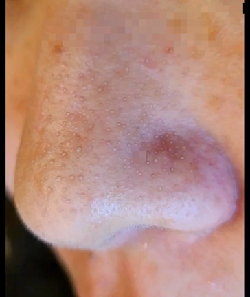 毛穴洗浄トリートメント/エスクトラクションとはどんな技術？の記事動画