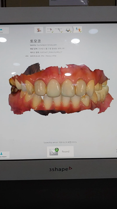 3Dスキャナー使用して即日仮歯装着　| フォシャールプラント歯科の記事動画