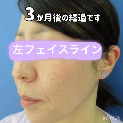 スクリュースレッドリフト④の記事動画