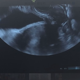 稽留流産の診断 エコー写真あり 42歳高齢出産 お空の息子と共に