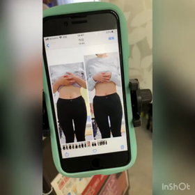 肋骨矯正の画像