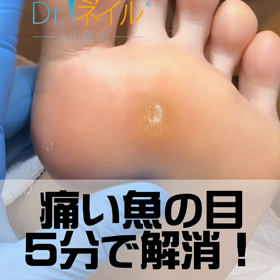 痛い魚の目5分で解消！の画像