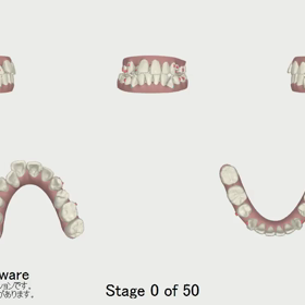 クリンチェックの画像