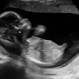 第二子のクアトロ検査の画像