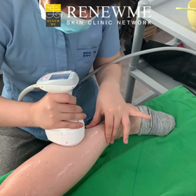 ふくらはぎハイフの画像