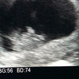 10w4d 悪阻の画像