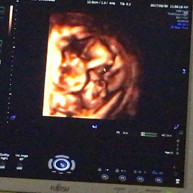 14w6d 妊婦健診の画像