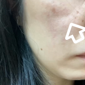 顔面神経による頬のピクピク改善。の画像