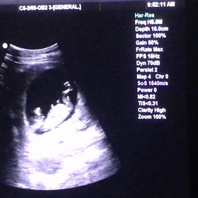 ⑧妊娠(OBGYN3回目)14週の画像