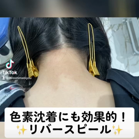 リバースピールで色素沈着を薄く！の画像