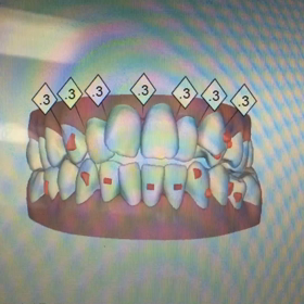 クリンチェックの画像