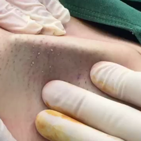 閲覧注意❗️ワキガ治療動画の画像