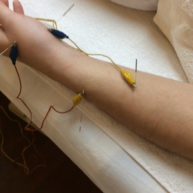 骨折の治療法。の画像