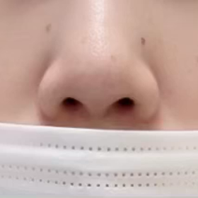 鼻を小さくするのはボトックス？の画像