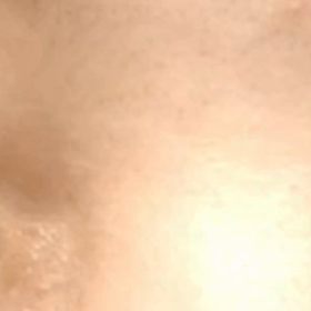 二重切開　4年と2ヶ月(動画あり)の画像